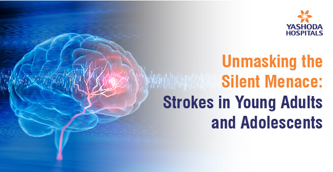 Unmasking the Silent Menace:  Strokes in Young Adults and Adolescents