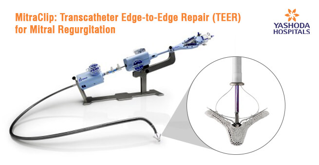 MitraClip for Mitral Regurgitation - Transcatheter Edge-to-Edge Repair