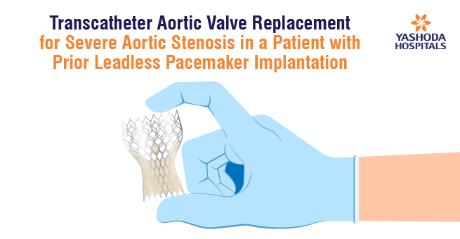 Transcatheter Aortic Valve Replacement