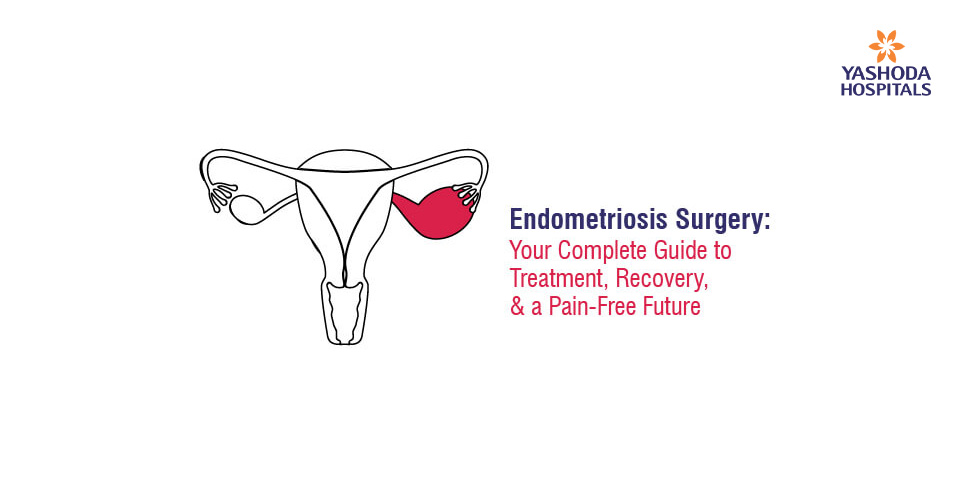 Endometriosis Surgery: Your Complete Guide to Treatment, Recovery, and a Pain-Free Future