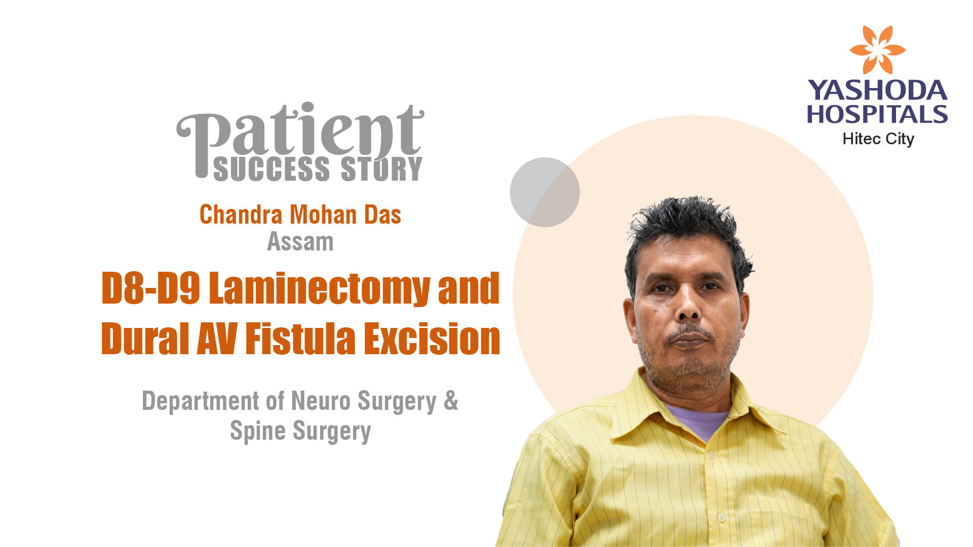 D8-D9 Laminectomy and Dural AV Fistula Excision