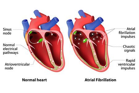 Atrial Fibrillation & Atrial Flutter  class=