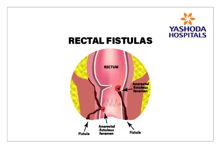 Anal Fistula  class=