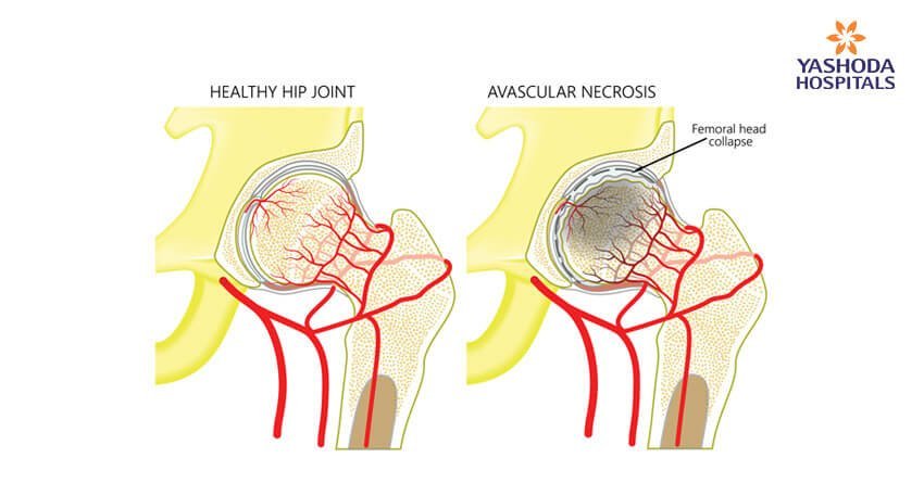 What are the causes of avascular necrosis